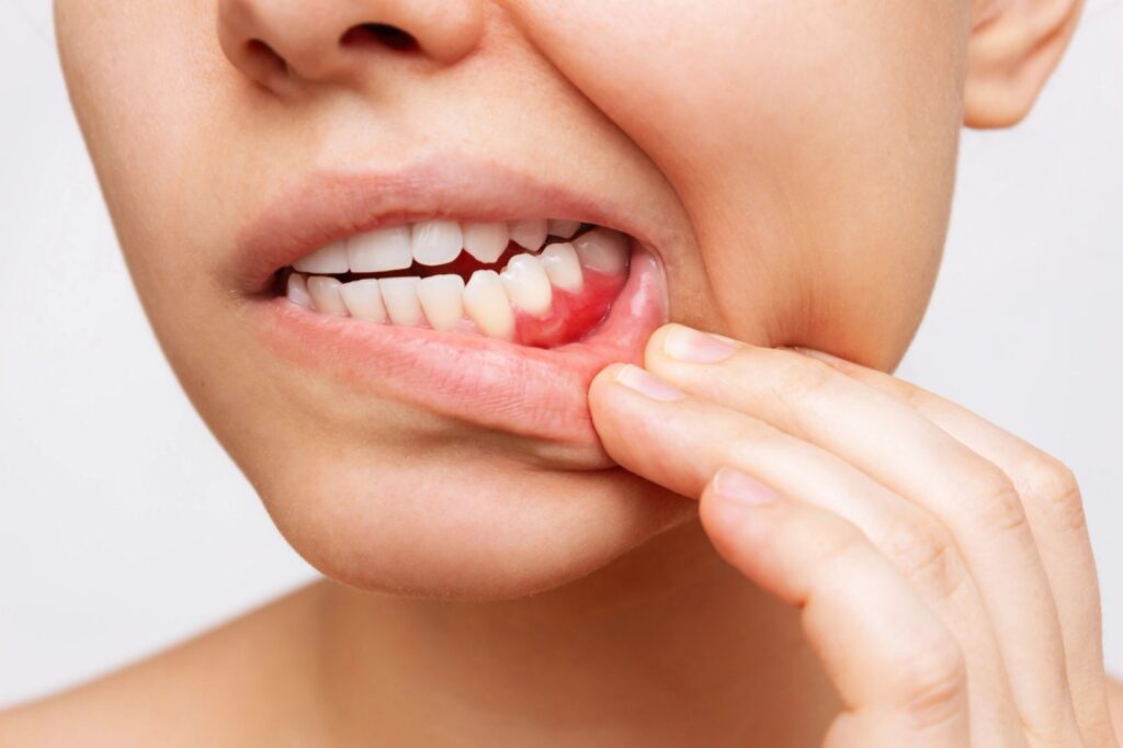 Gum Disease In Trinity: Early Signs, Treatment Options, And Prevention That Lasts Close-up of a person pulling down their lip to show inflamed red gums.