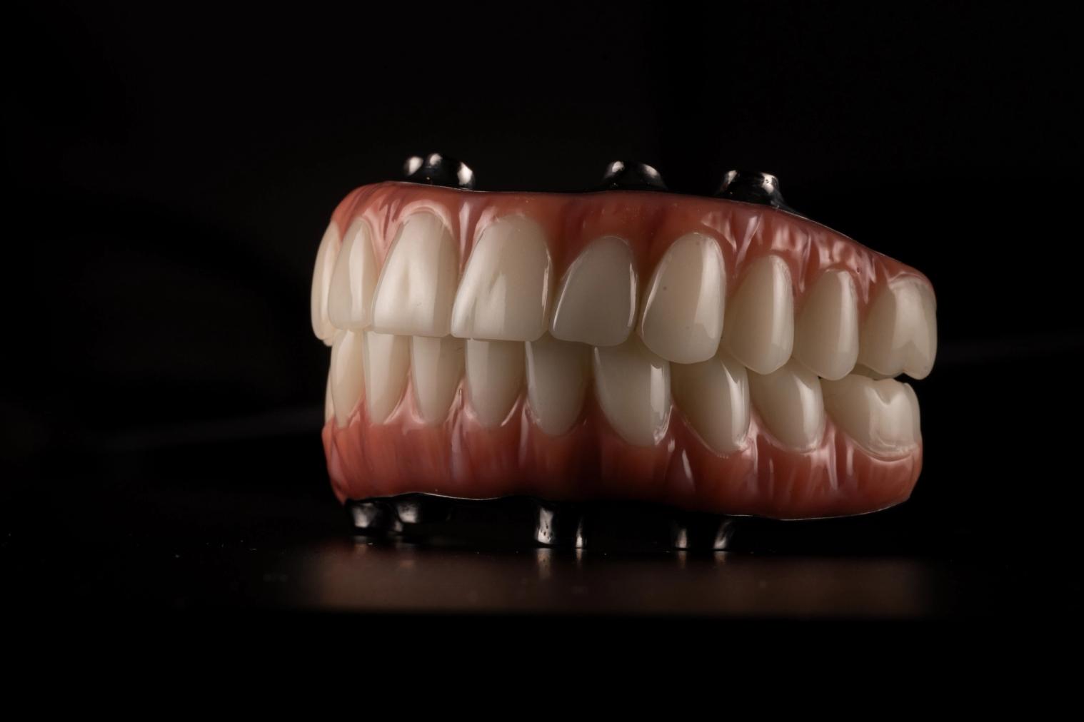 Full-arch dental prosthesis on implants. Full-arch dental prosthesis on implants.