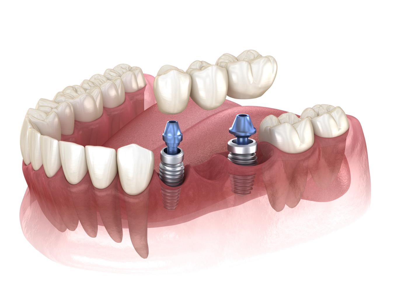 A 3D model of a lower jaw with two dental implants and a bridge. A 3D model of a lower jaw with two dental implants and a bridge.