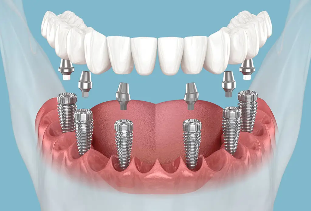 All-on-X Fixed Implants in Trinity: What Makes a Full-Arch Smile Feel Natural?