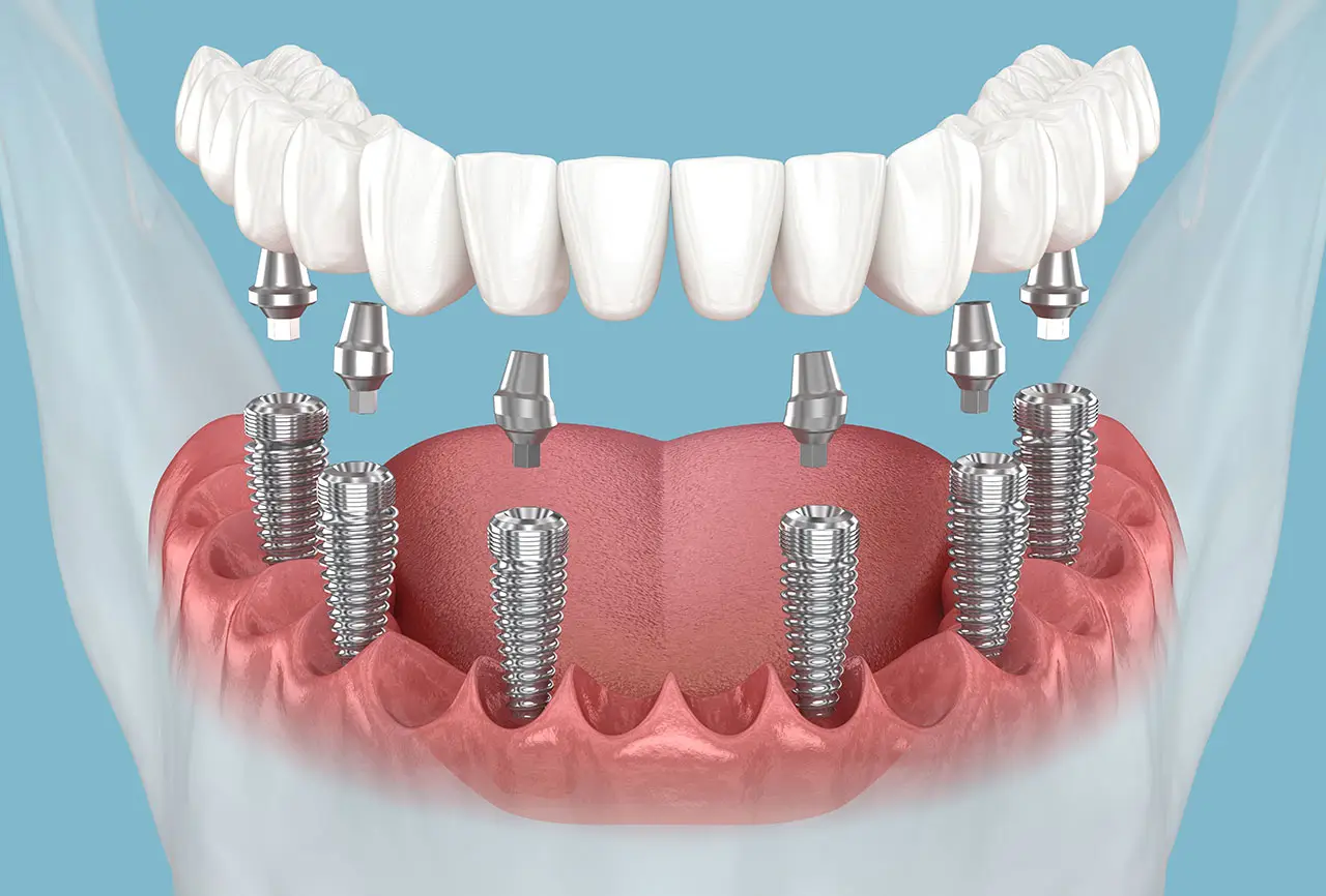 All-on-X Fixed Implants in Trinity: What Makes a Full-Arch Smile Feel Natural?
