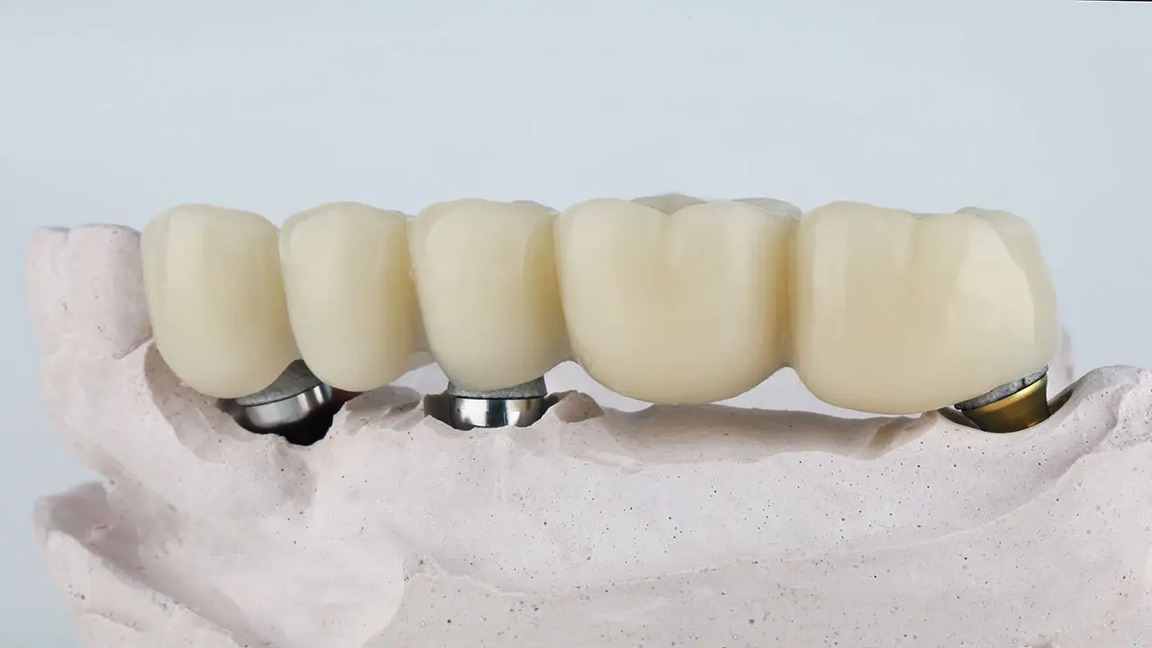 Implant Bridges in Trinity: When Two or More Missing Teeth Need One Coordinated Solution