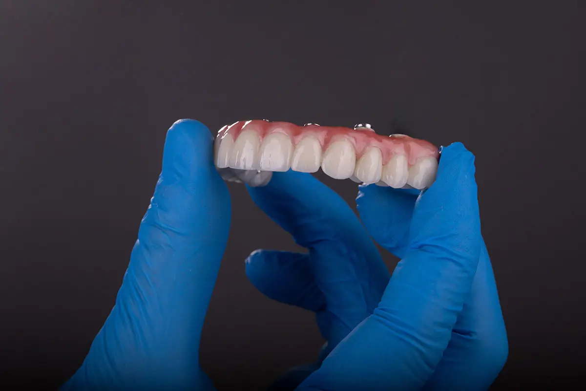 All-on-X Fixed Implants in Trinity: Temporary Teeth vs. Your Final Full-Arch Smile