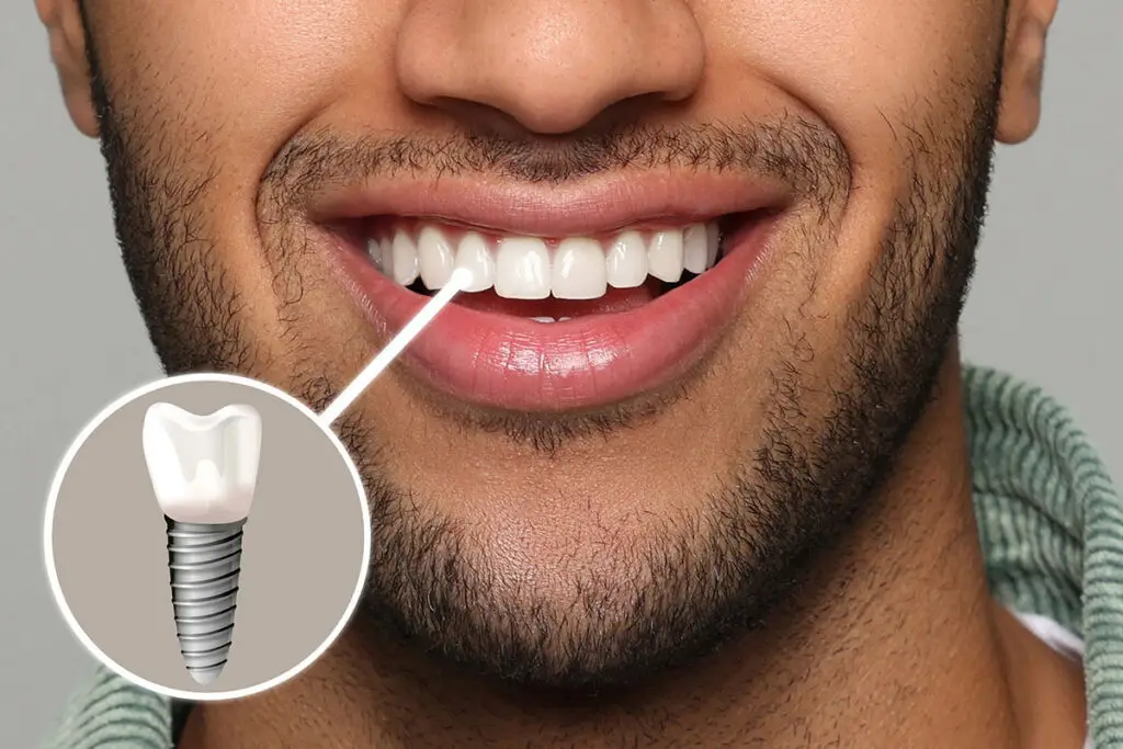 Dental Implants in Trinity: Immediate vs. Delayed Implant Placement After Tooth Extraction